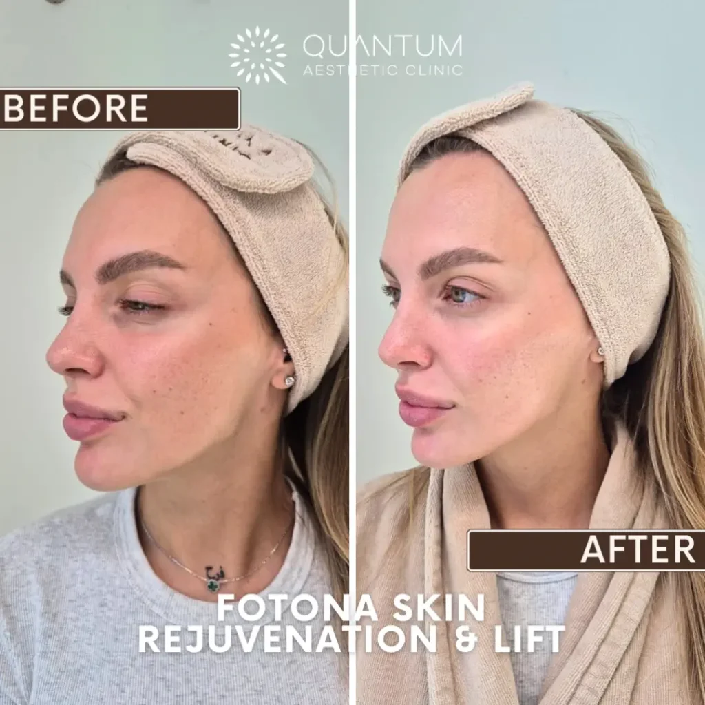 Fotona Skin Rejuvination & Lift