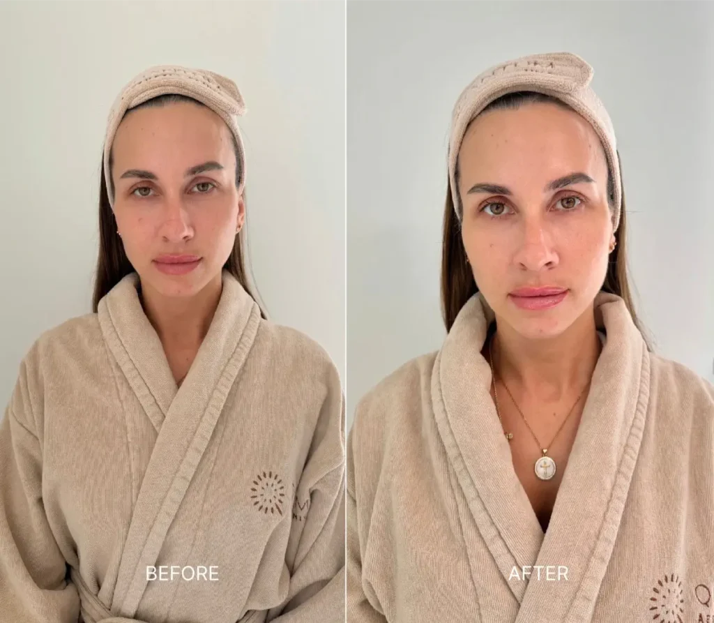 Before and after dermal fillers